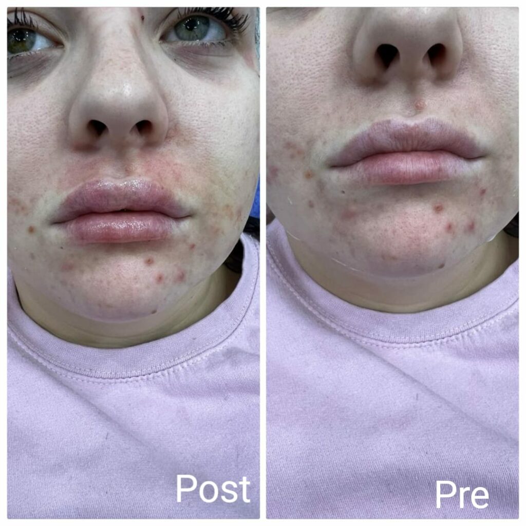 Lip filler with the best lip filler doctors